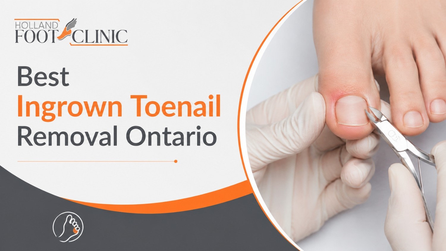 ingrown toenail removal in Ontario at Holland Foot Clinic
